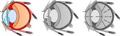 A Brief Overview of Glaucoma: Cause, Symptom and Gene Therapy Research