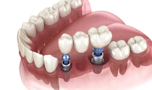 Same Day Dental Implants: The Fast Track to a Perfect Smile