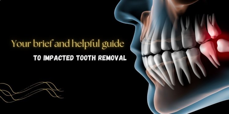 Your brief and helpful guide to impacted tooth removal