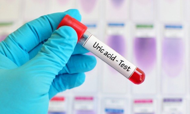 Uric Acid Test: Importance, Procedure, and Results