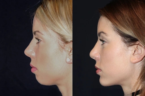 Best Aesthetic Clinic in dubai: Enhance Your Chin with Professional Chin Fillers